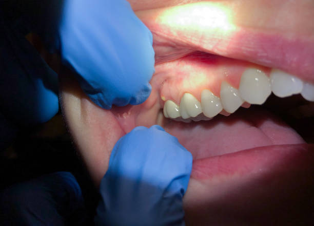 Best Emergency Dental Care for Broken or Chipped Teeth in Carrabelle, FL
